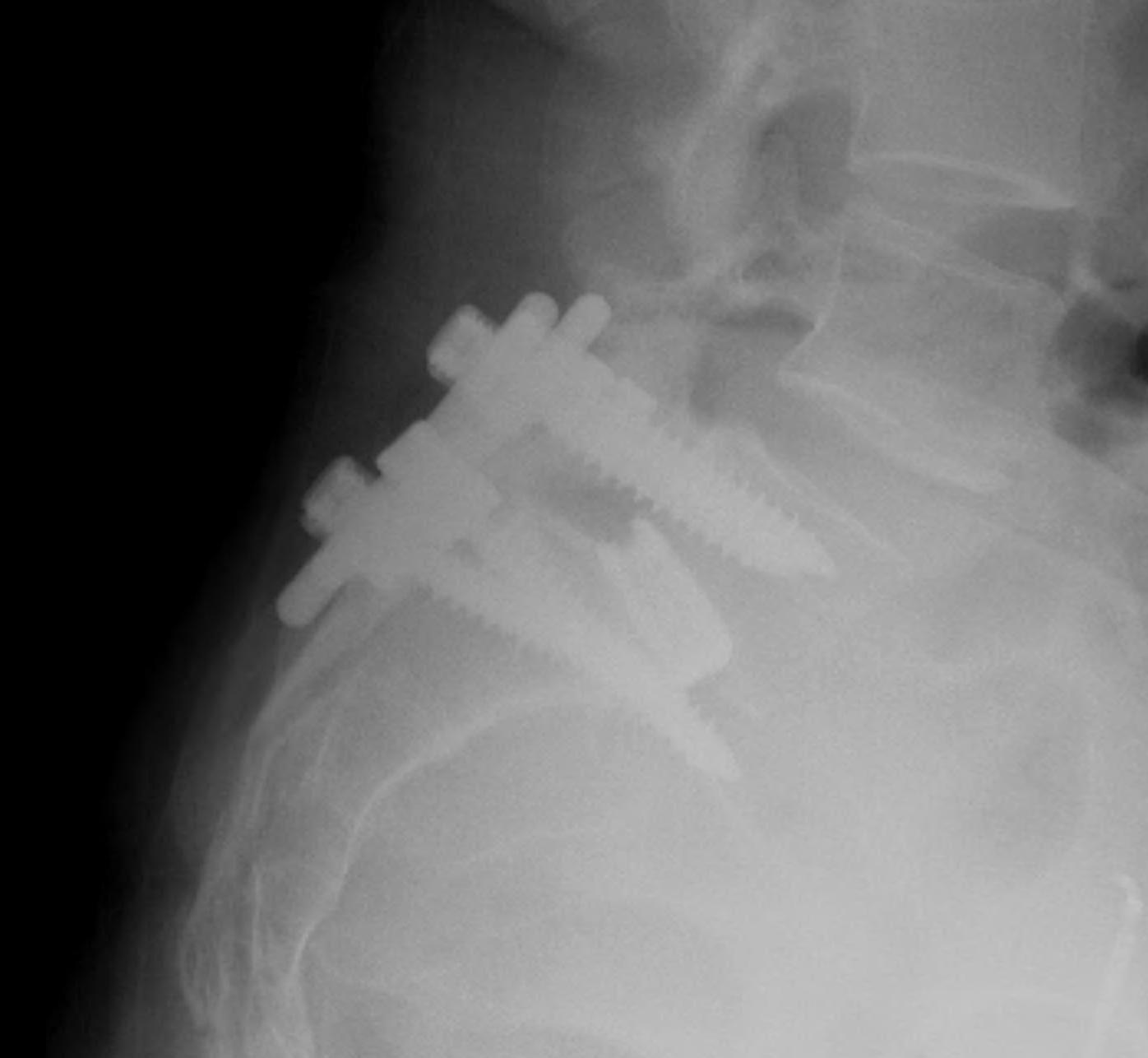 Isthmic Spondylolithesis PLIF